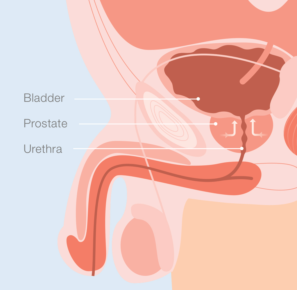 Illustration of enlarged prostate